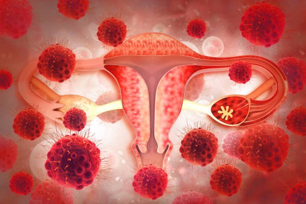 Exploring Cervical Cancer: A Comprehensive Guide With 7 Essential ...